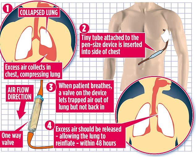 new-gadget-to-treat-collapsed-lungs-will-allow-thousands-of-britons-to