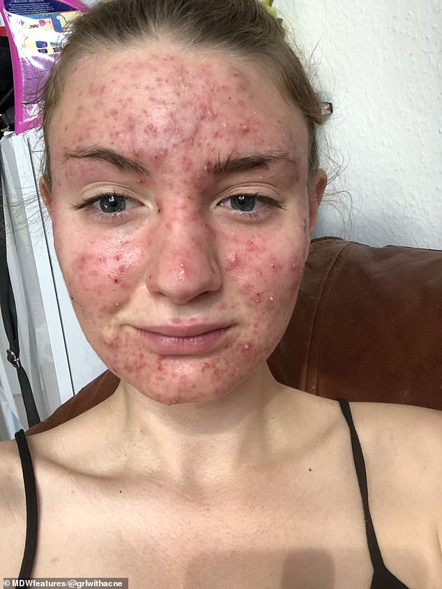 Woman Who Had Cystic Acne So Severe That It Affected Her Sight Readsector