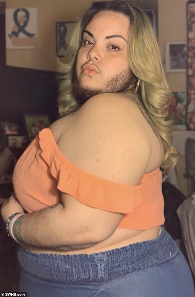 Woman 27 With Excess Facial Hair Caused By Polycystic Ovary Syndrome